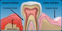 Gum Disease Myths Debunkes Columbia SC