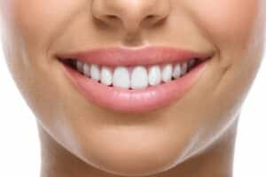 Retainers After Braces: How to Keep Your Best Smile